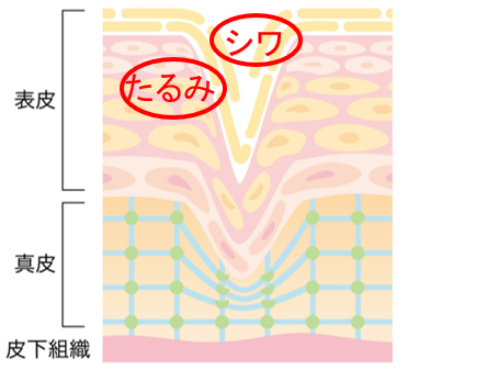 図解：シワ、たるみの断面図