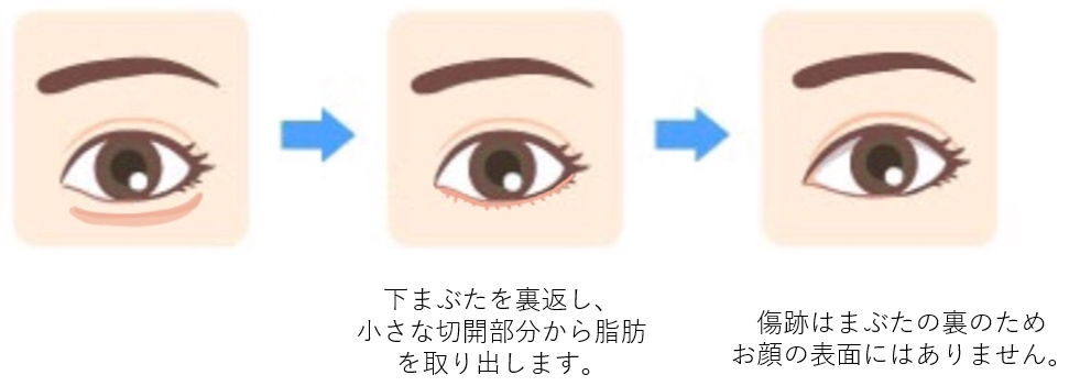 下まぶたを裏返し、小さな切開部分から脂肪を取り出します。傷跡はまぶたの裏のためお顔の表面にはありません。